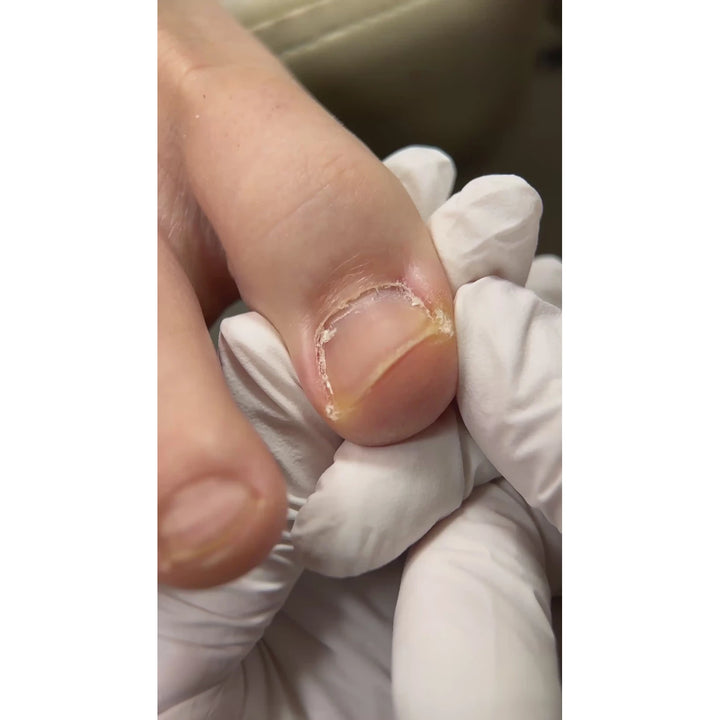 SHELLY Amaciador para unhas encravadas, 30 ml