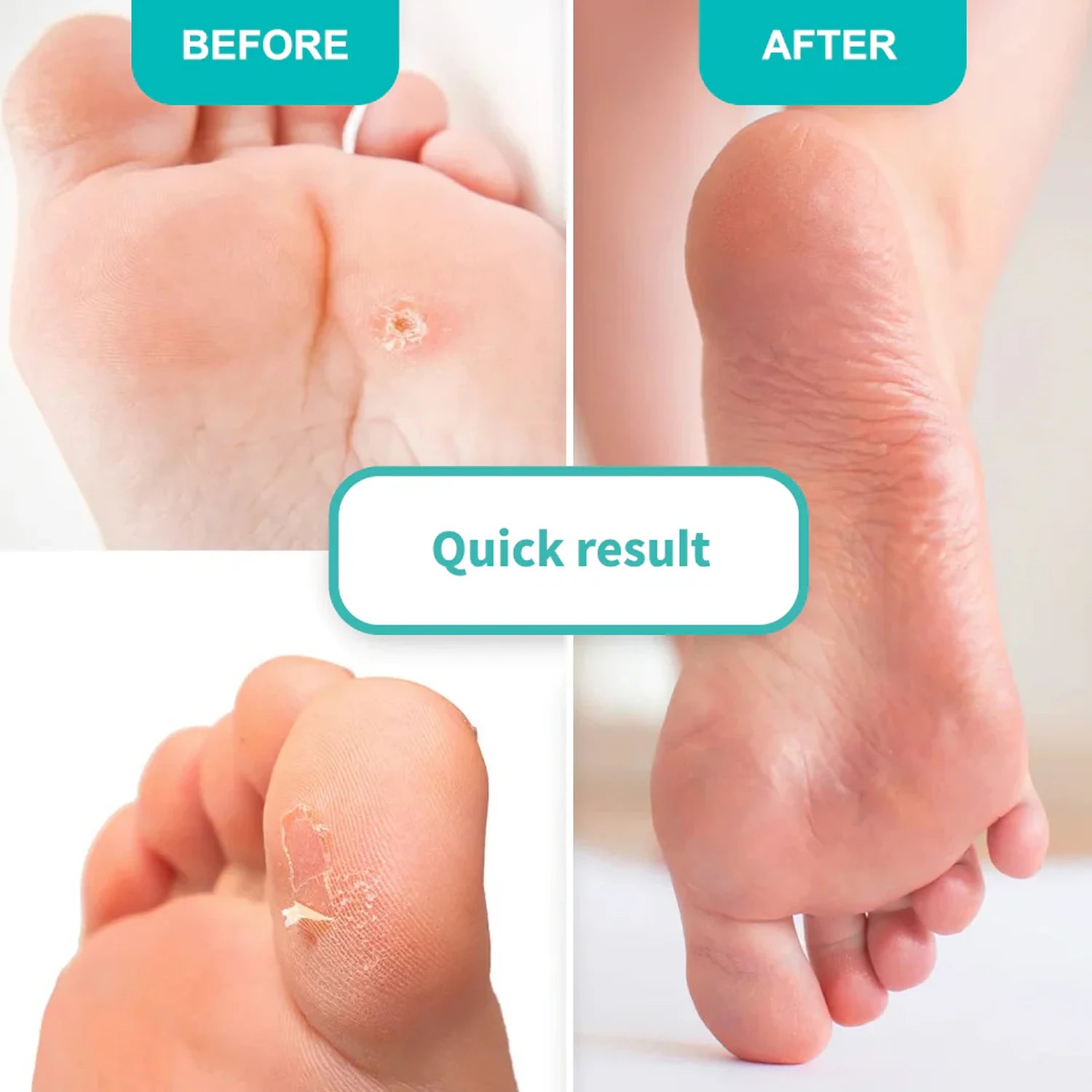 Before and after results of foot callus removal using softening gel, showing smooth skin.